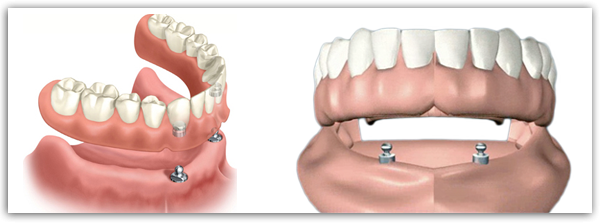 denture implants