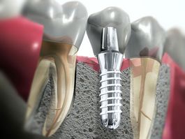 Cosmetic Dental Implants (Preston)