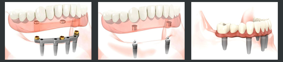 implant-dentures-fixed-dentures
