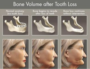 why-replace-missing-teeth-with-dental-implants