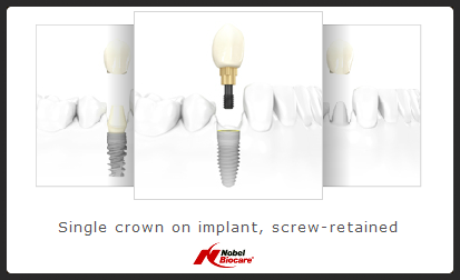 new tooth in a day with implants